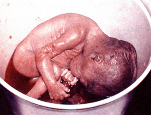aborted-baby-in-bucket